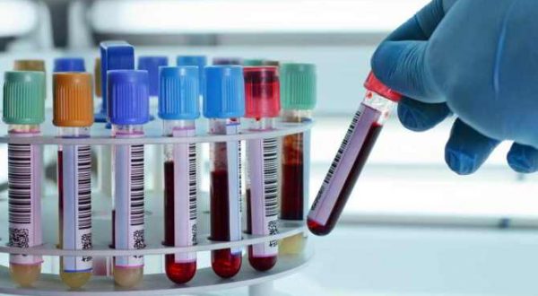 Laboratorijska pretraga omjer albumin/kreatinin